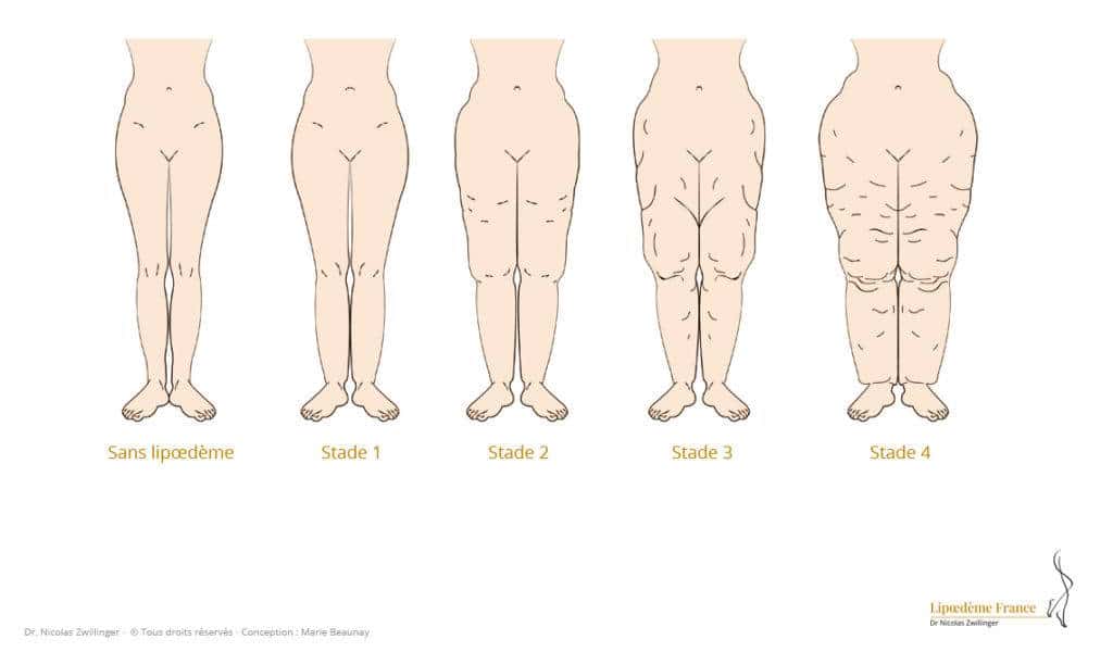 The 4 classifications of lipedema The 4 classifications of lipedema