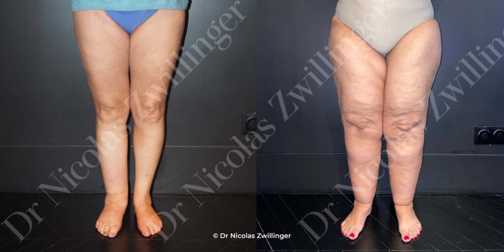 Le lipoedème se différencie du lymphœdème