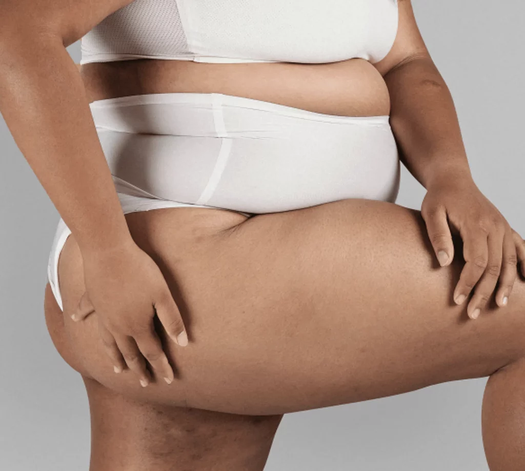 detecter image dr nicolas zwillinger clinique Lipœdème.png