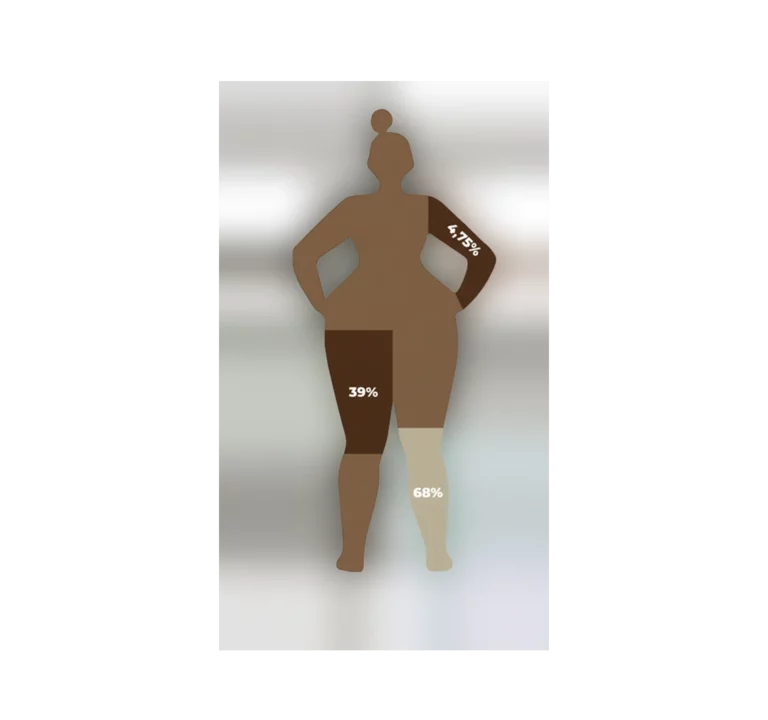 operation lipoedème