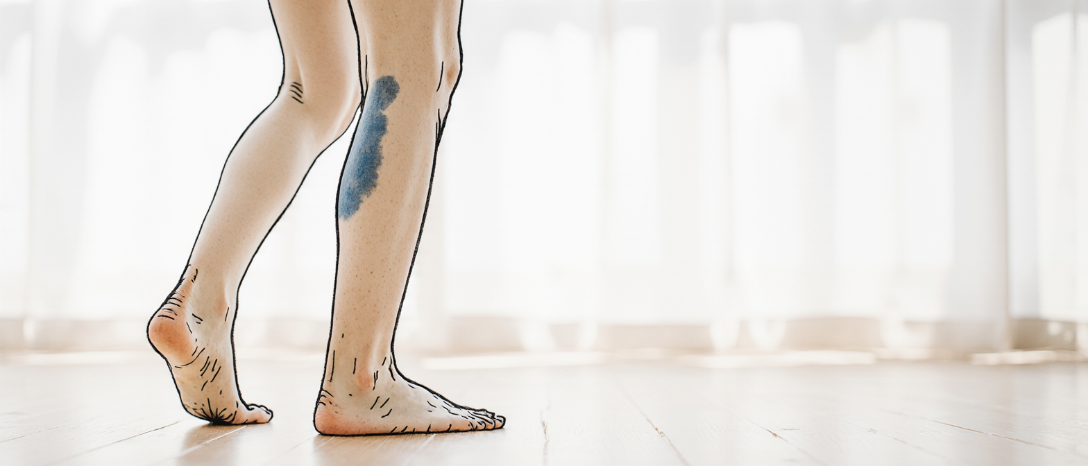 Comment lutter contre la fragilité vasculaire