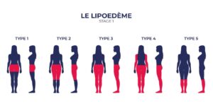 lipoedème membres supérieurs