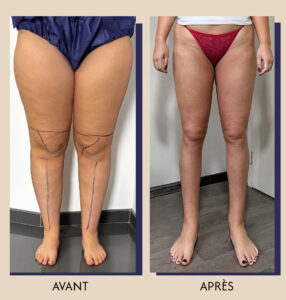 Media 1 TEST 3 LIPO copie e1783504086830